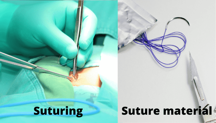 Means Surgical Suturing To Close A Wound